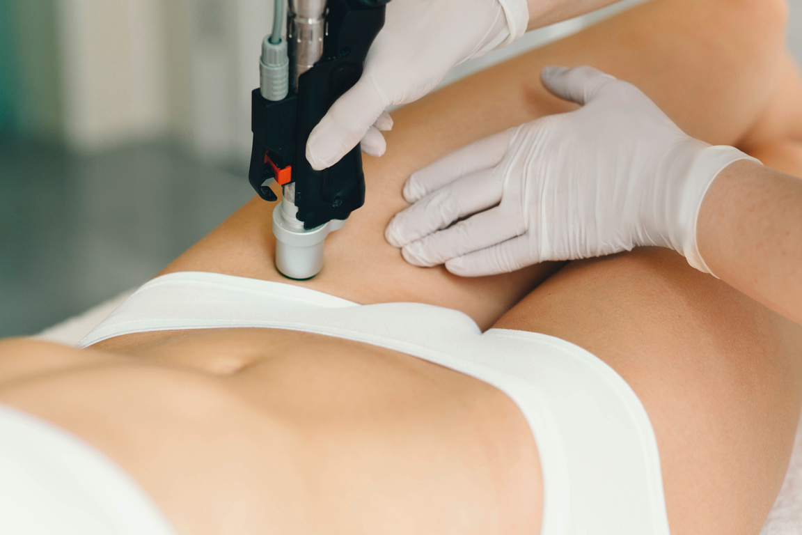 Bikini line laser hair removal